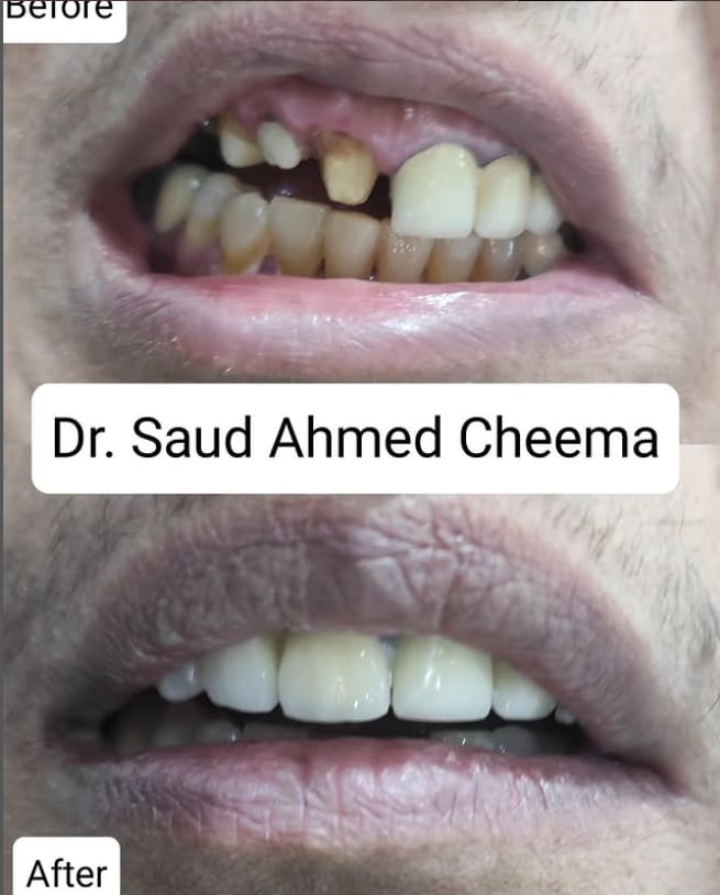 Full upper-arch reconstruction using crowns or veneers for damaged and missing teeth.