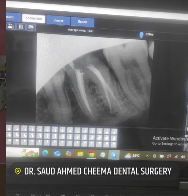 Dental X-ray showing a completed root canal treatment on a molar.