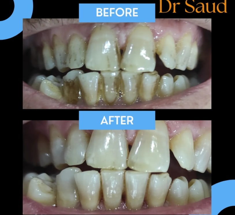 Scaling & Polishing procedure demonstrating effective removal of deposits from tooth surfaces.