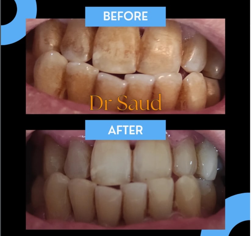 Deep cleaning procedure targeting extensive plaque buildup and discoloration.