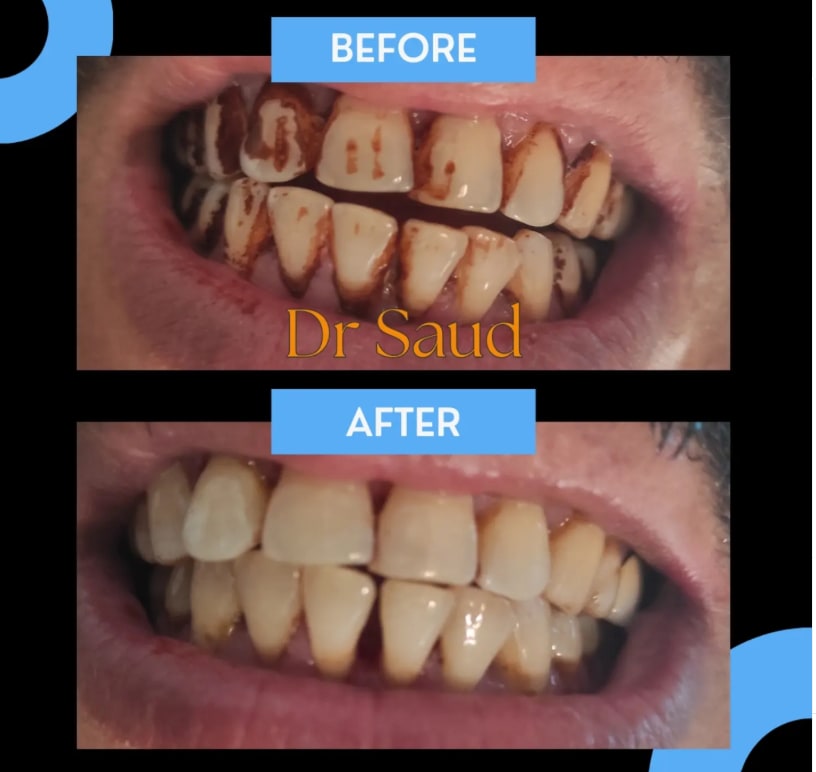 Removal of heavy nicotine and dietary stains through scaling and polishing.