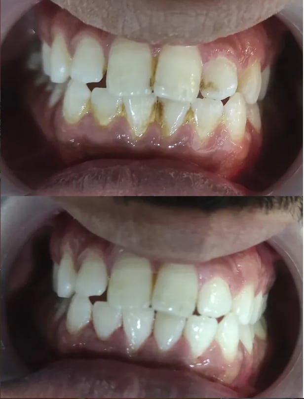 Close-up of dental cleaning targeting tartar at the gumline.