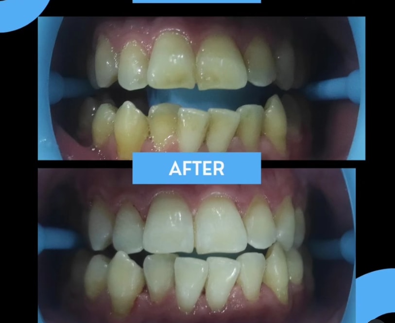 Results of a professional whitening session using of a lip retractor.