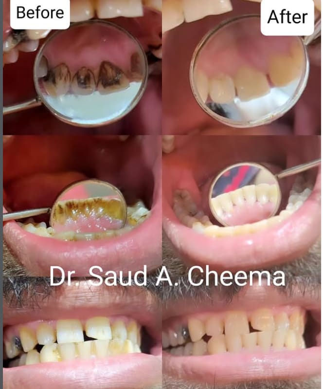 Scaling and polishing procedure removing tartar (calculus) and plaque buildup for improved oral hygiene.