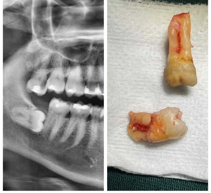 Horizontal impaction identified on X-ray and successful post-extraction result. - Performed at Dental Pearl Clinic Lahore