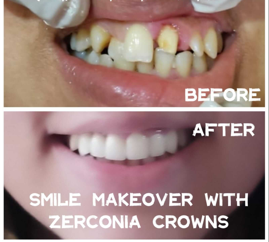 Anterior malalignment corrected with a premium zirconia crown—smile transformed. - Performed at Dental Pearl Clinic Lahore
