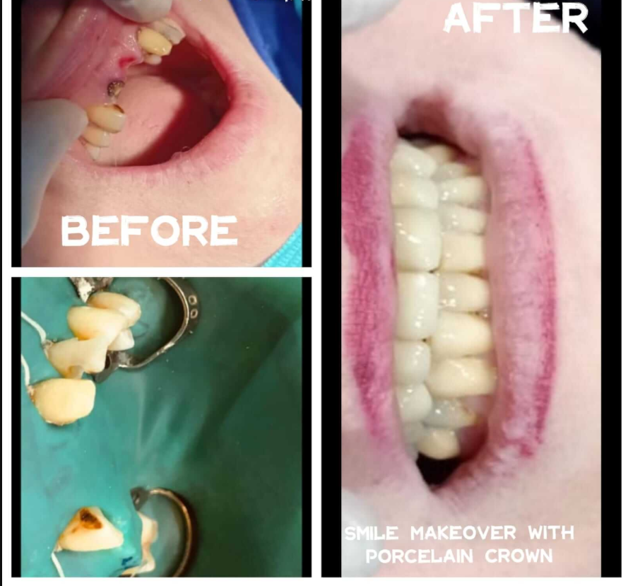 Smile restored using high-strength PFM crowns. - Performed at Dental Pearl Clinic Lahore