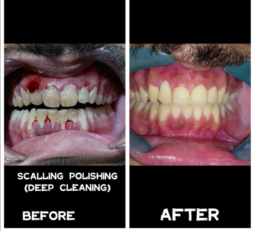 Pre-op recession and calculus vs. post-op deep cleaning with restored gum health. - Performed at Dental Pearl Clinic Lahore