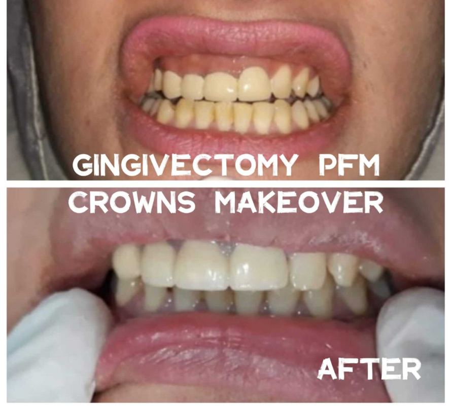 Before: Uneven crowns. After: Symmetrical, aesthetic smile post-gingivectomy. - Performed at Dental Pearl Clinic Lahore