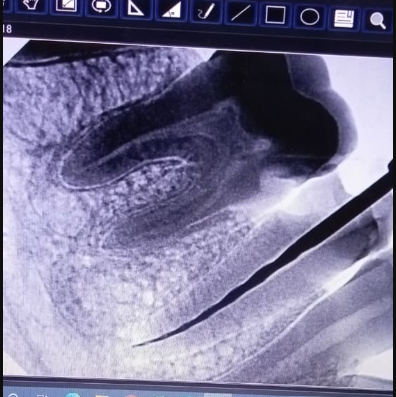 Root canal treatment (RCT):Infected tooth treated with painless root canal therapy to preserve natural tooth structure. - Performed at Dental Pearl Clinic Lahore