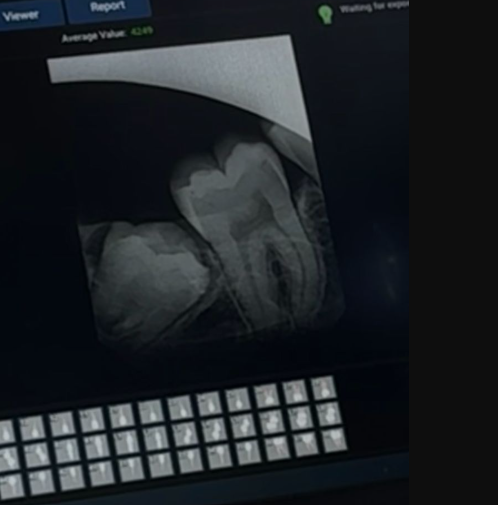 Impacted wisdom tooth safely removed with precise surgical planning and fast recovery. - Performed at Dental Pearl Clinic Lahore