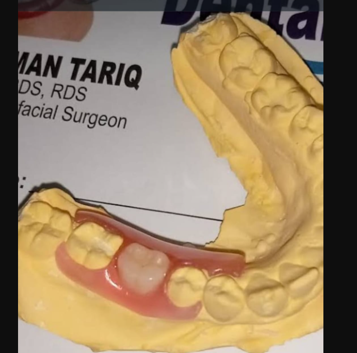 Comfortable flexible denture designed for a secure fit and natural smile restoration. - Performed at Dental Pearl Clinic Lahore