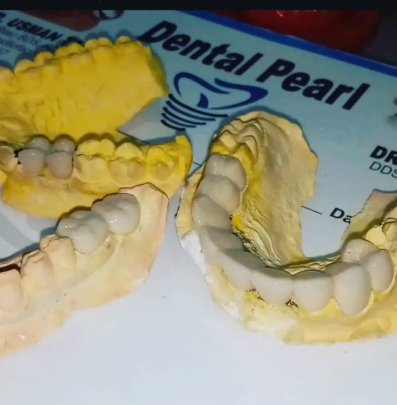 Smile restored using durable PFM crowns and bridges with functional and aesthetic results. - Performed at Dental Pearl Clinic Lahore