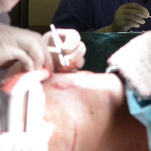 donor grafts fue transplant