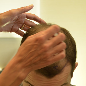 hair transplant in turkey