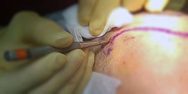 Manual Graft Implantation