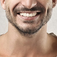 beard transplant in turkey