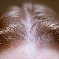 women hair transplant applications