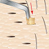 Step 4: Implanting Donor Grafts