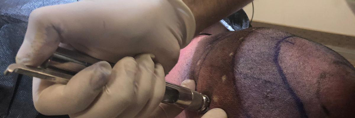 needle-free painless anesthesia for hair transplantation