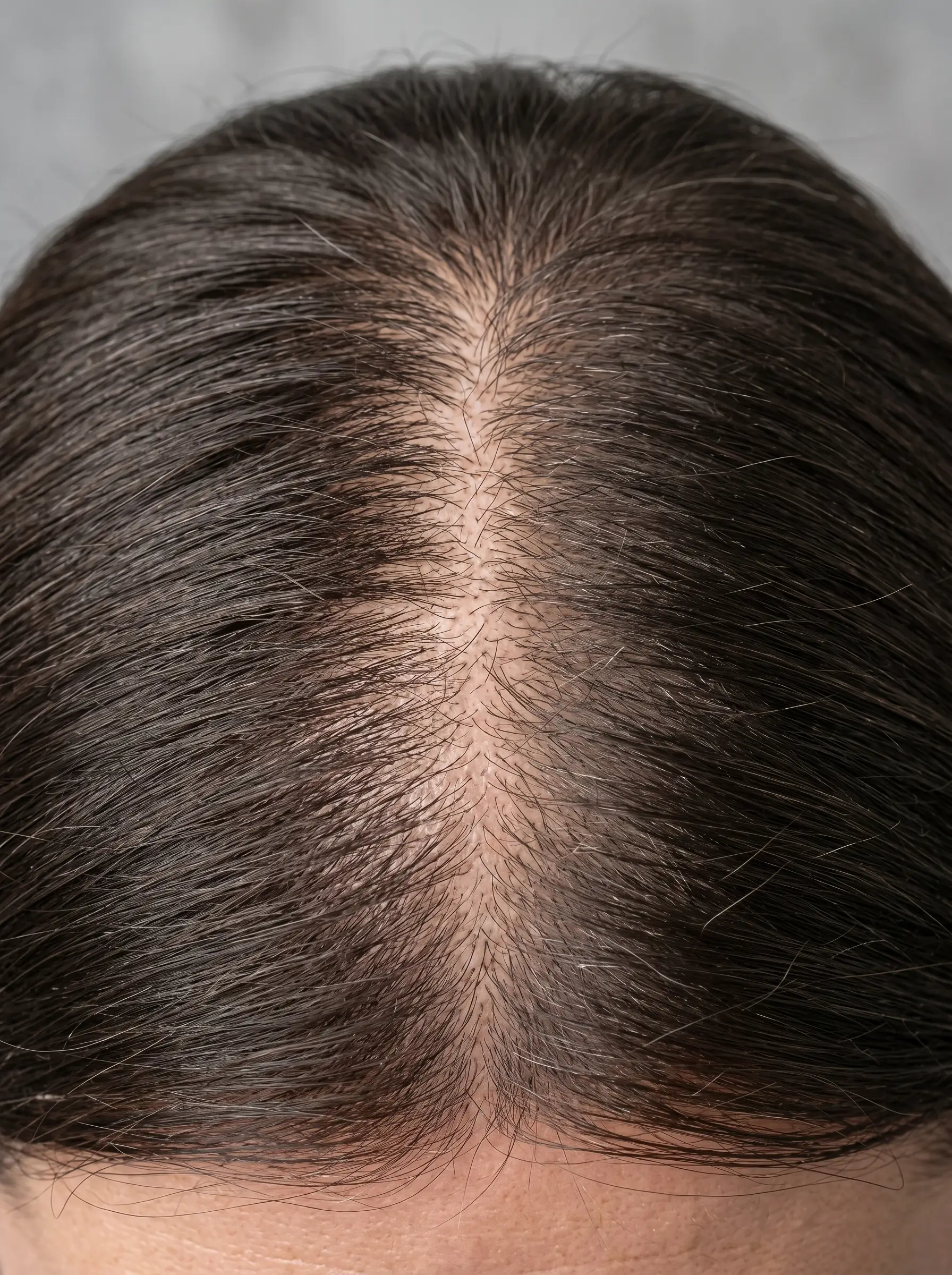 Scalp thinning