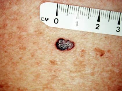 Пермские онкологи проверят березниковских пациентов