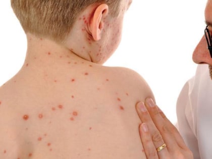 В апреле в Пермском крае зарегистрировали первые завозные случаи кори