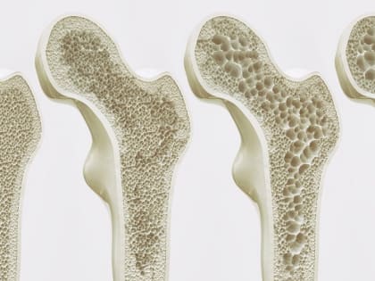 Здоровье костей