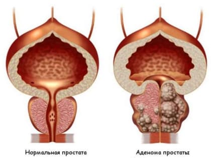 Аденома простаты