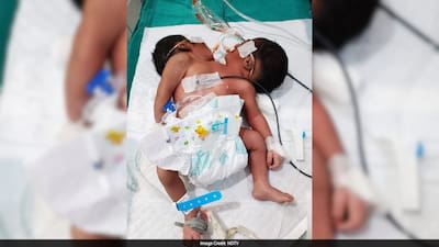 ഒഡിഷയിൽ രണ്ട് തലയും ഒരു ശരീരവുമുള്ള ഇരട്ടക്കുട്ടികൾ ജനിച്ച് ഒരാഴ്ചയ്ക്കുശേഷം മരിച്ചു