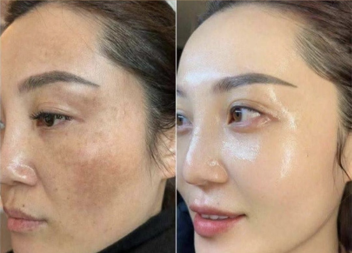 Antes y después · Pigmentación y arrugas