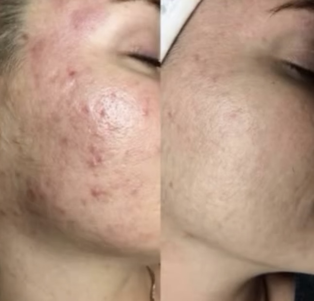 Antes y después · Arrugas y marcas profundas