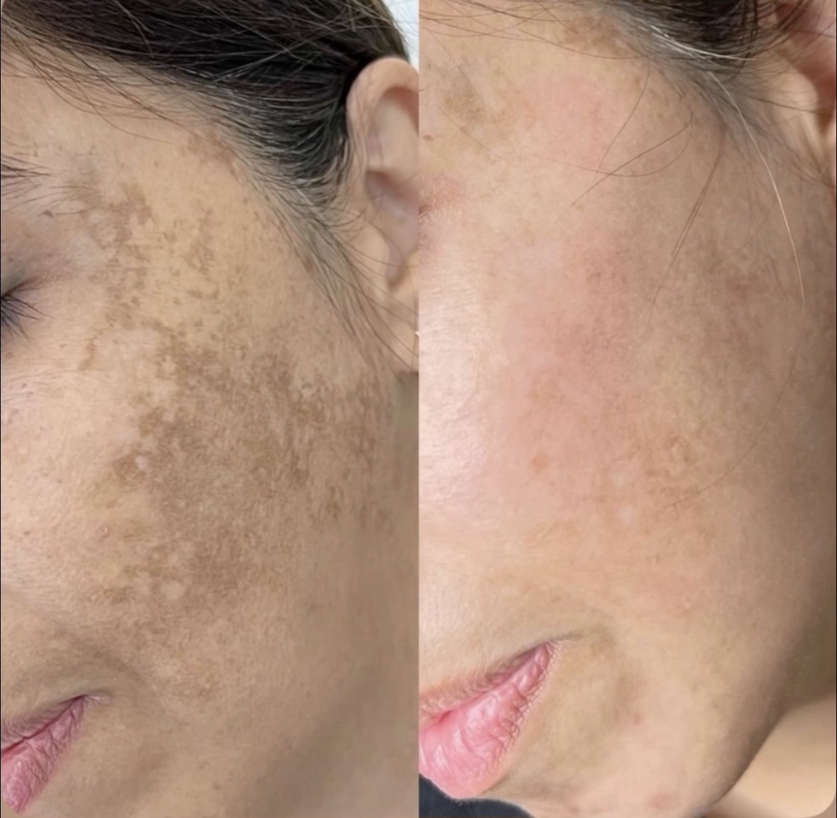Antes y después · Mascarilla de colágeno