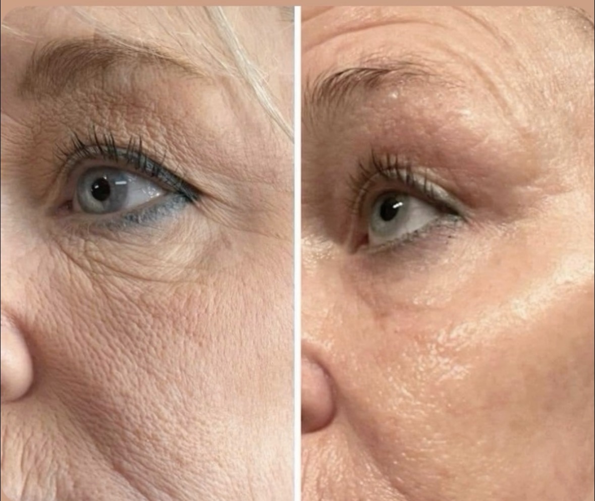 Antes y después · Mascarilla de colágeno