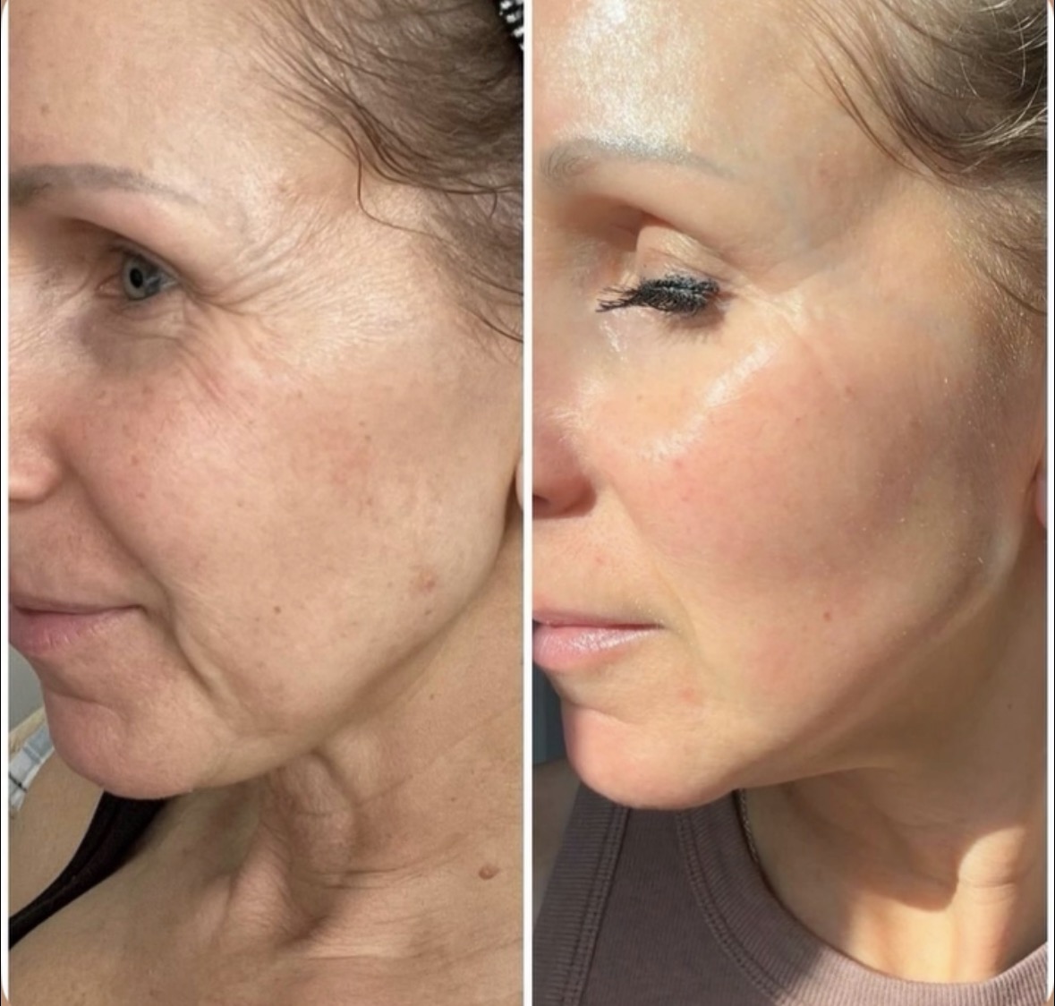 Antes y después · Manchas faciales