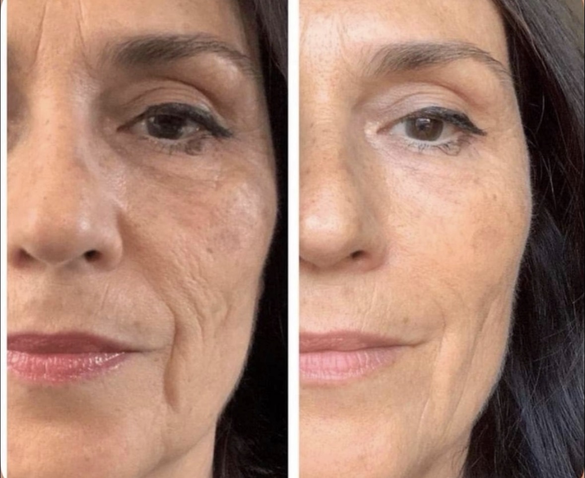 Antes y después · Acné activo
