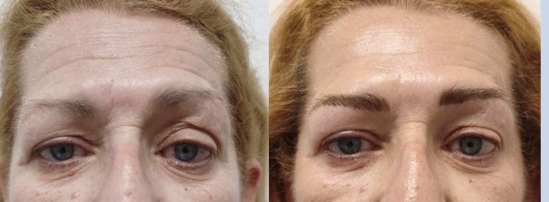Antes y después · Opacidad y ojeras