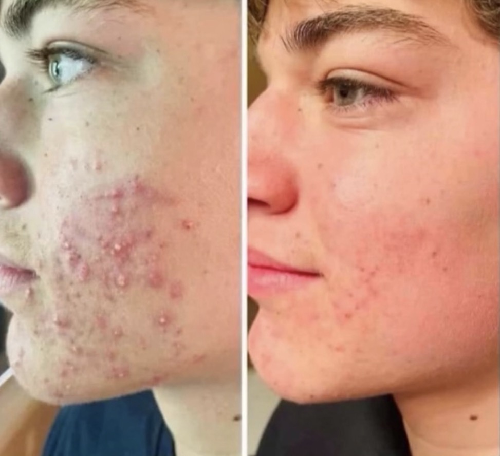 Antes y después · Flacidez facial