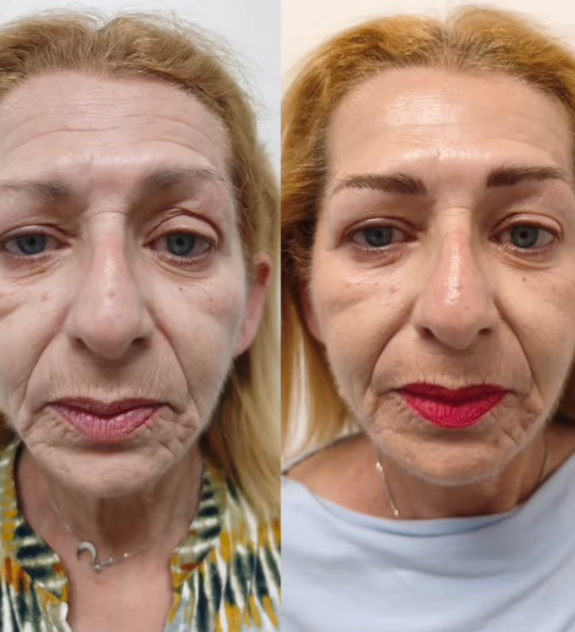 Antes y después · Manchas de la edad