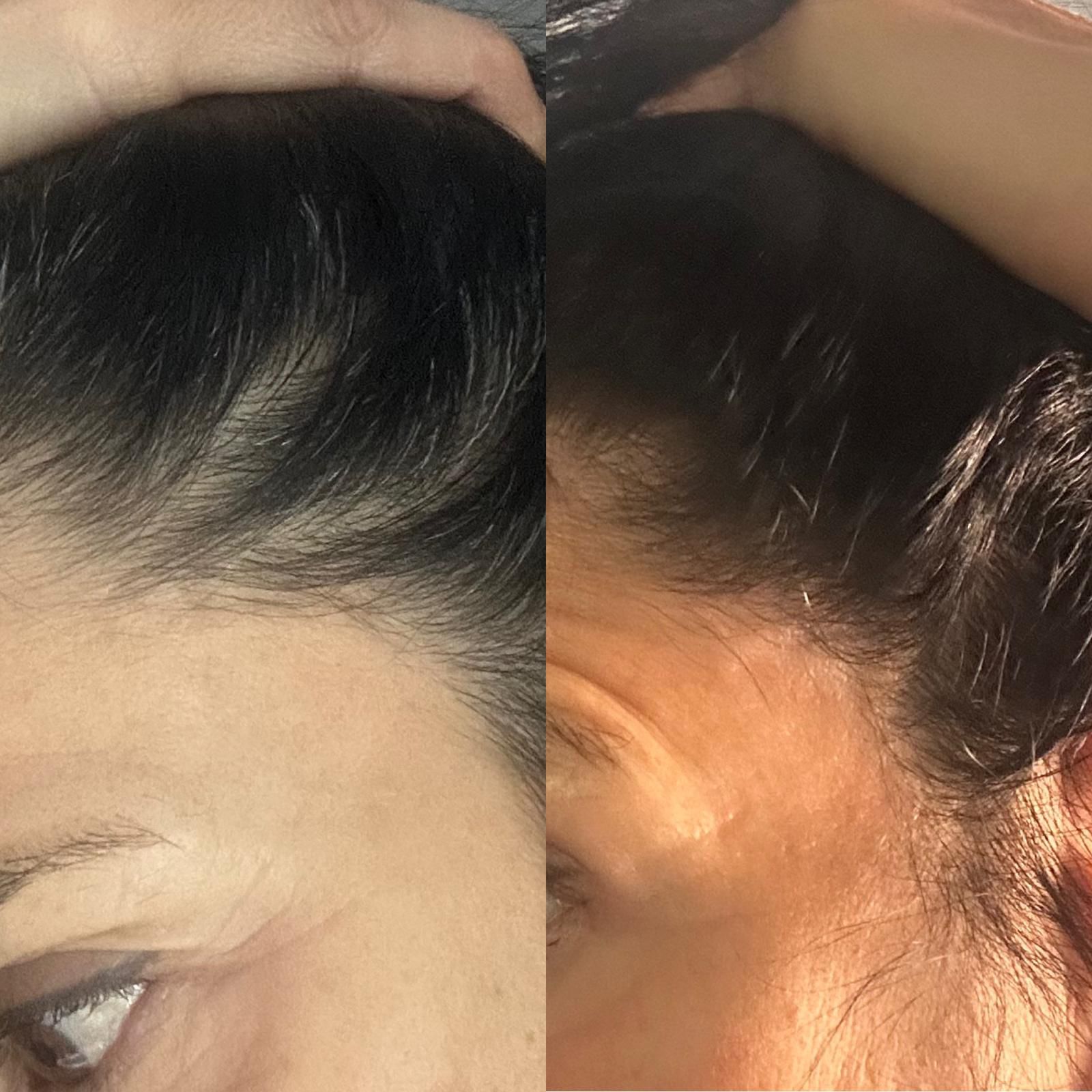 Antes y después · Flacidez facial
