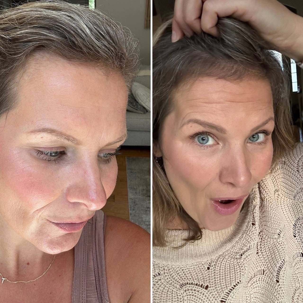 Antes y después · Flacidez facial