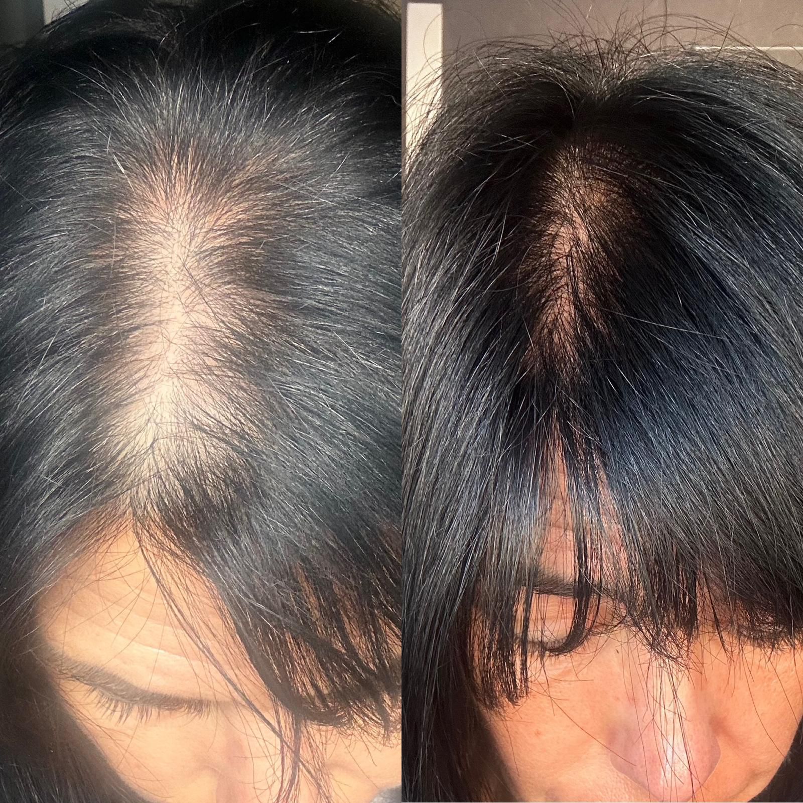 Antes y después · Flacidez facial