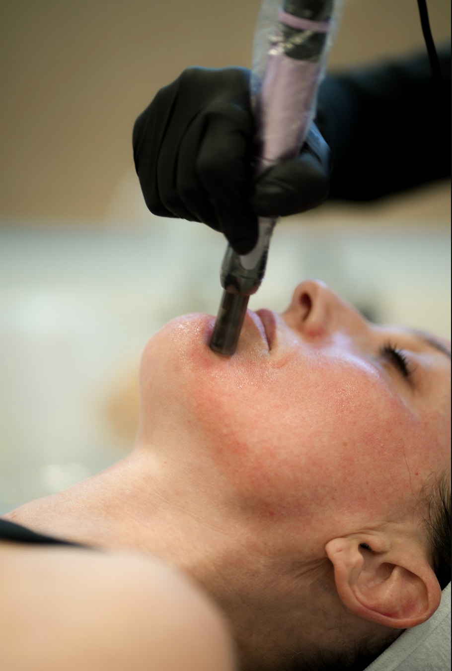 Microneedling