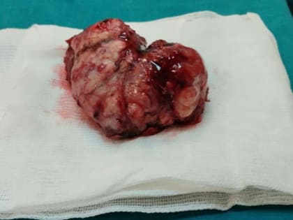 Врачи Челнов удалили 72-летнему мужчине огромную опухоль головного мозга