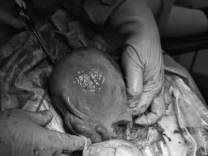 Врачи РКБ удалили пациентке огромную опухоль яичника сразу после кесарева