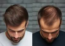 Hair Transplant FUE at UMANG Hospital Bilaspur