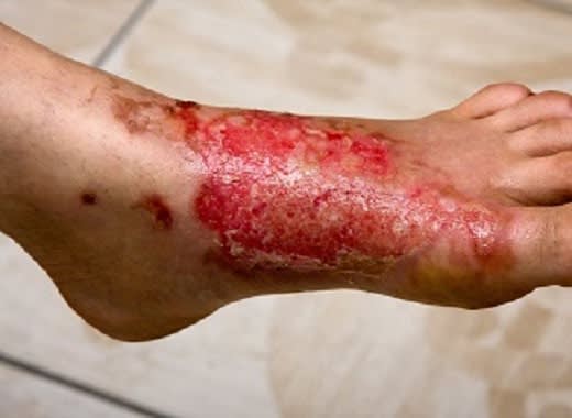 Burn Wound at UMANG Hospital