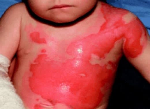 Pediatric burn at UMANG Hospital