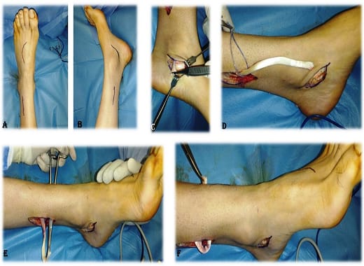 Foot Drop at UMANG Hospital