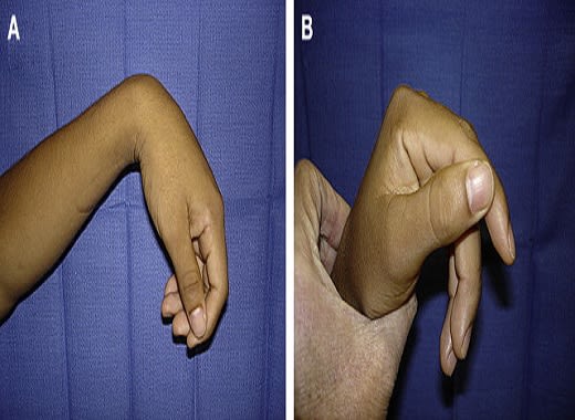 Tendon Transfer at UMANG Hospital